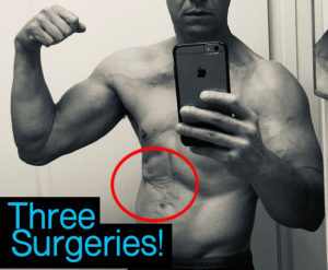 How Long Does it Take to Get Abs? | Cancer Survivorship | Tips from ...
